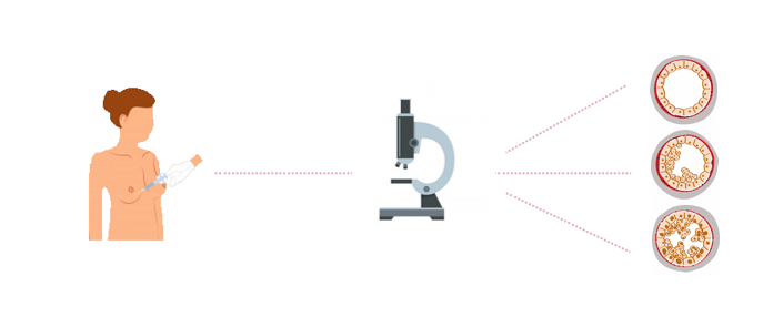 sabatino-d-archi-chirugia-oncoplastica-tumore-del-seno-diagnosi