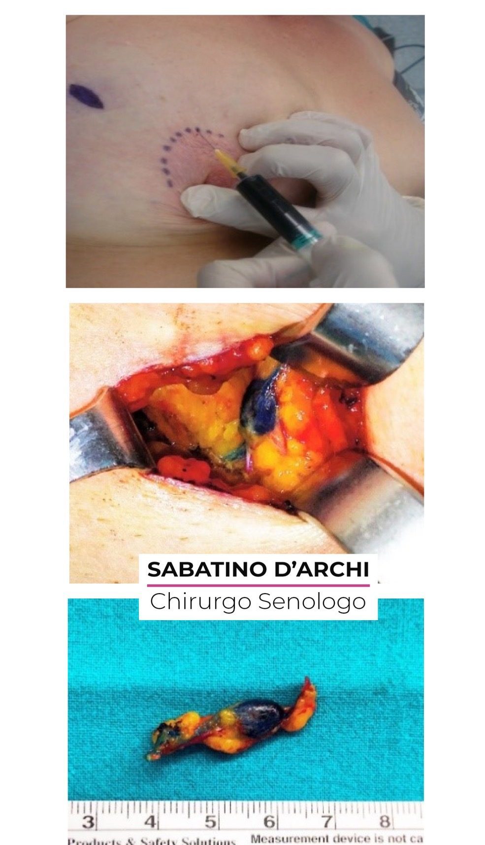 dottor-sabatino-d-archi-chirurgo-senologo-attivita-chirurgica-biopsia-del-linfonodo-sentinella